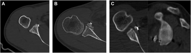 Postoperative CT examples of complete, partial and absent coracoid graft healing after Latarjet