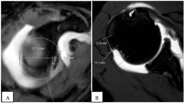 MR arthrogram measurements demonstrating an off-track Hill-Sachs lesion