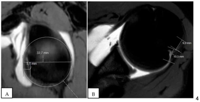 MR arthrogram measurements demonstrating an on-track Hill-Sachs lesion