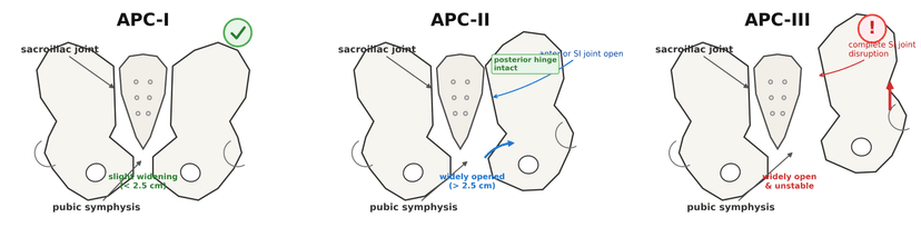 Anteroposterior Compression (APC) Pelvic Injuries | OrthoVellum