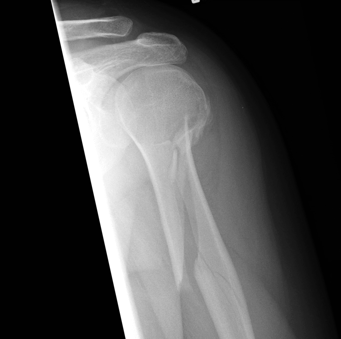 AP radiograph of the proximal humerus showing a spiral fracture of the humeral shaft
