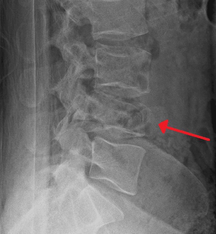 Lateral plain radiograph of the lumbar spine with an arrow marking a burst fracture of L4 showing loss of vertebral body height.