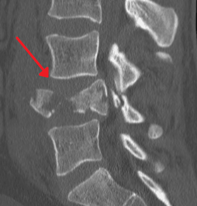 Sagittal CT reconstruction of the lumbar spine with an arrow marking an L4 burst fracture with retropulsion.