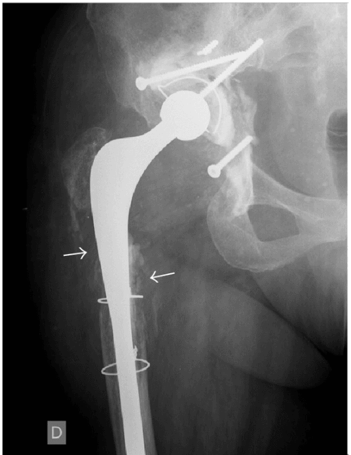 Overview of the target pathology: anteroposterior hip radiograph of an infected, loosened total hip arthroplasty with extensive periprosthetic osteolysis (prosthetic joint infection).