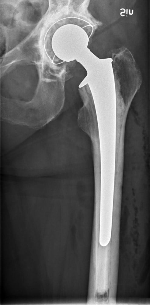 Overview/introduction image: anteroposterior radiograph of a well-functioning, well-seated total hip arthroplasty - the successful outcome optimisation protects.