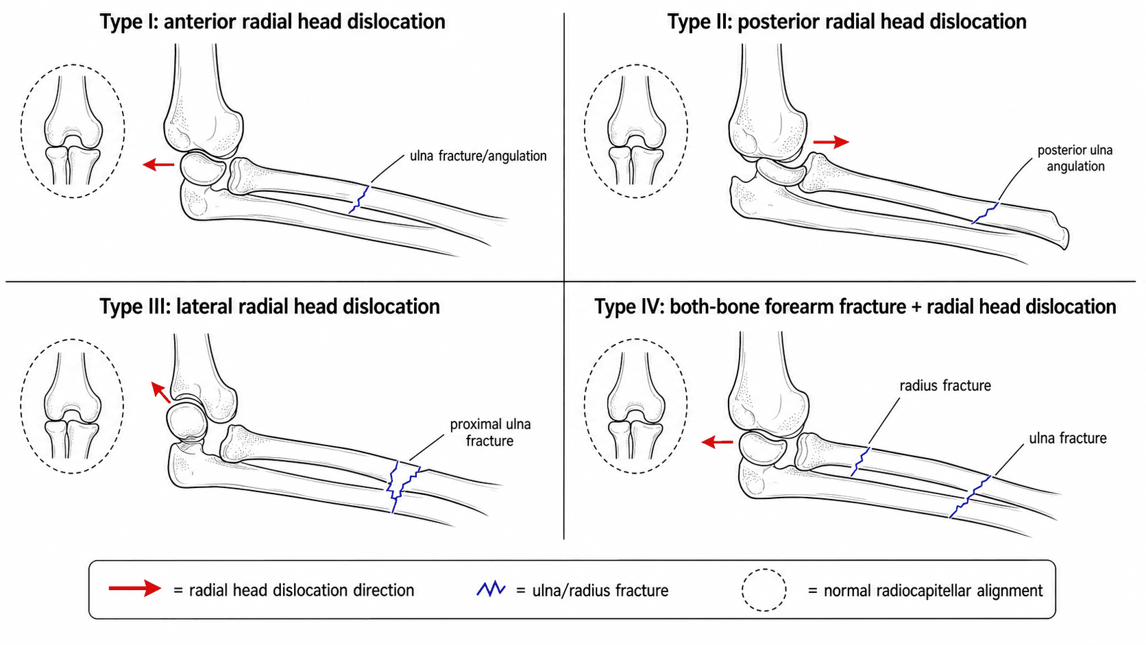 Bado classification of Monteggia fractures: Type I anterior, II posterior, III lateral radial head dislocation, IV both-bone