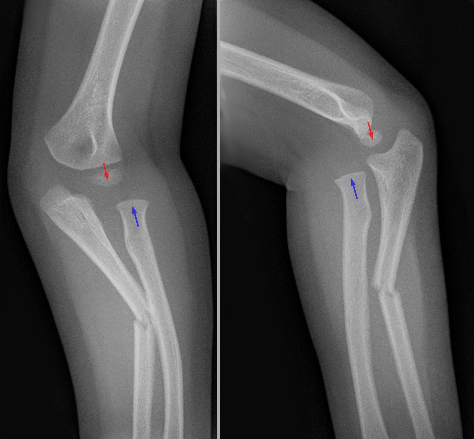 Annotated AP and lateral elbow radiographs of a paediatric Monteggia injury, with the dislocated radial head and the ulnar fracture marked.