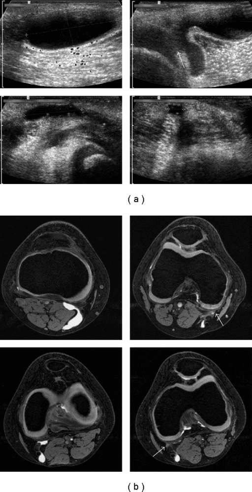 Ultrasound and MRI comparison of bilateral Baker's cysts