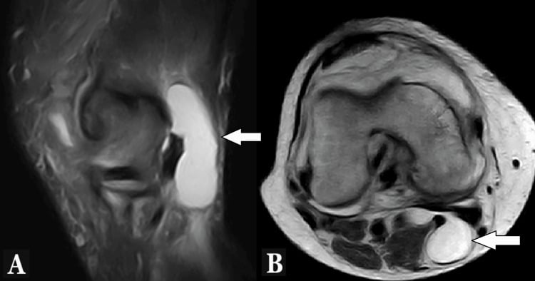 Sagittal and axial MRI showing a Baker cyst communicating with the knee joint