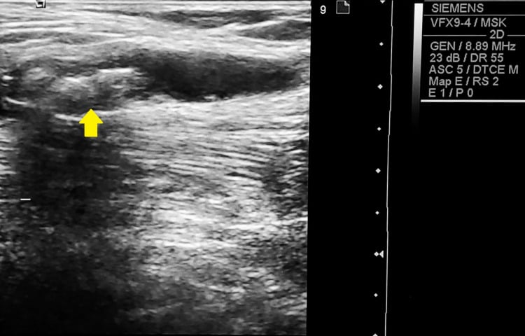 Ultrasound of a dissecting Baker cyst within medial gastrocnemius containing calcifications