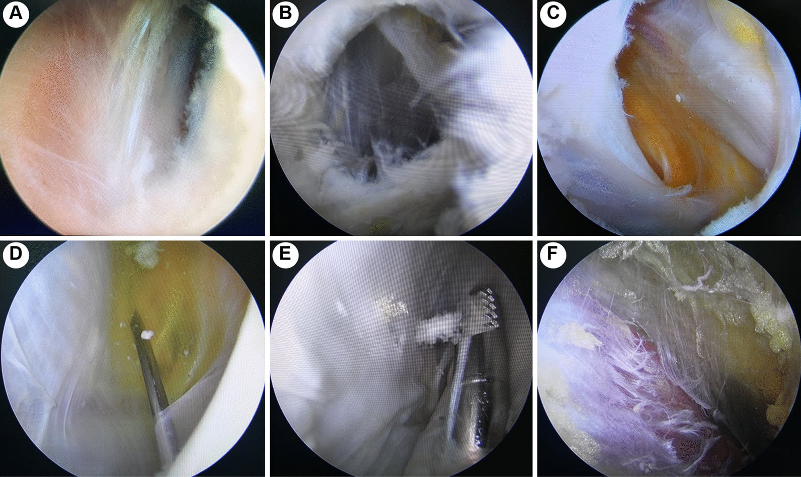 Arthroscopic sequence for popliteal cyst decompression through double posteromedial portals