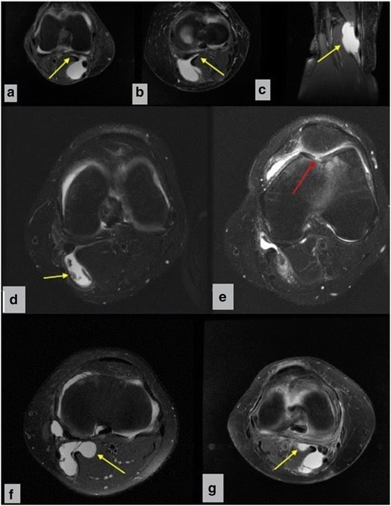 MRI spectrum of popliteal cyst morphology including communicating peduncle and loose bodies