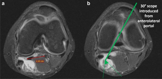 Axial MRI planning the relationship between a Baker cyst and the popliteal neurovascular bundle