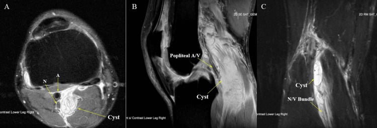 Multiplanar MRI showing a large popliteal cyst compressing posterior neurovascular structures