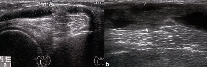 Serial ultrasound showing refilling and enlargement of a recurrent popliteal cyst
