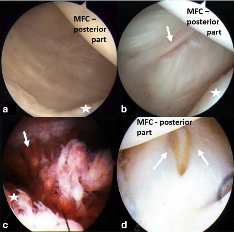 Arthroscopic views of posteromedial capsular valve mechanisms in popliteal cyst formation