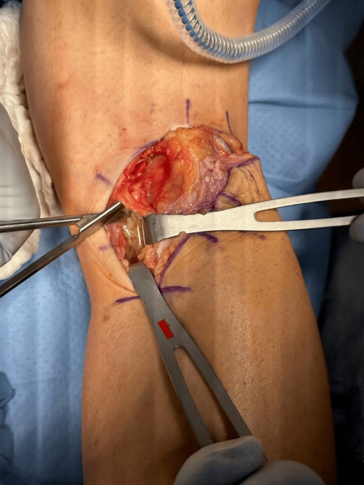 Open posterior approach exposing a popliteal cyst deep to medial gastrocnemius