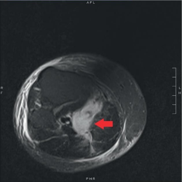 Axial MRI showing a ruptured Baker cyst with calf fluid extravasation and oedema