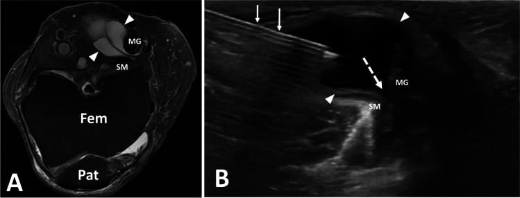 MRI and ultrasound sequence of image-guided aspiration of a septated popliteal cyst