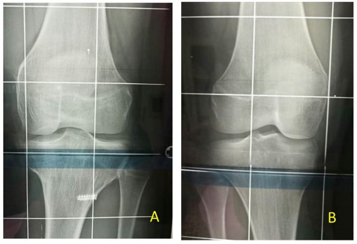 Bilateral follow-up knee radiographs after epiphysiodesis for Beckwith-Wiedemann syndrome