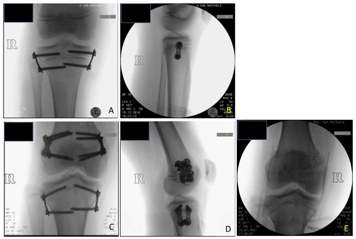 Serial knee radiographs of tibial and femoral epiphysiodesis for Beckwith-Wiedemann limb-length discrepancy