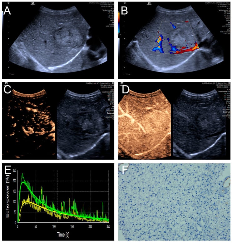 Ultrasound Doppler contrast-enhanced ultrasound and histology of paediatric hepatoblastoma
