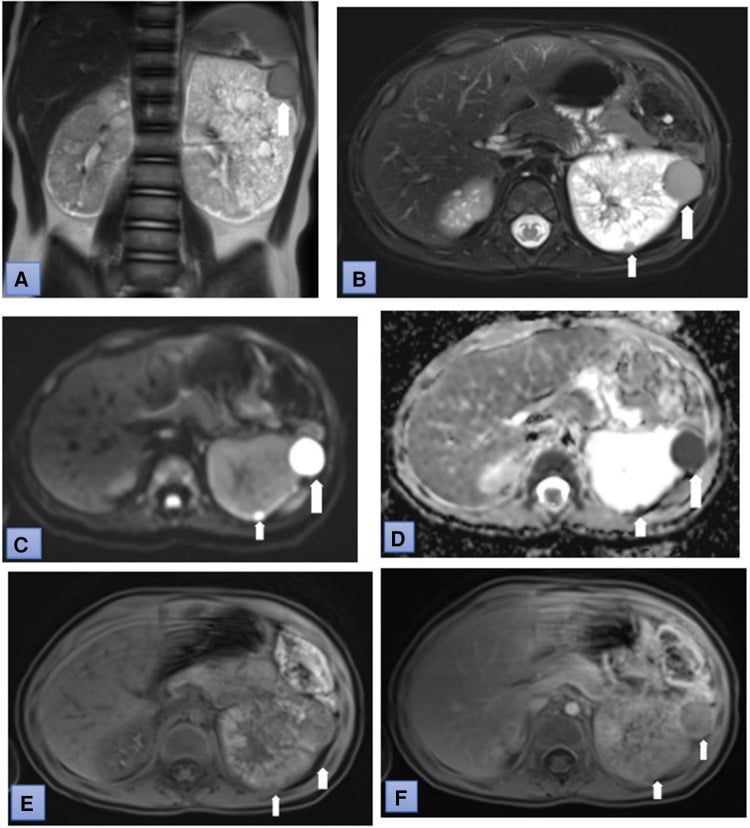 Multiparametric MRI showing multiple Wilms tumour lesions in a child