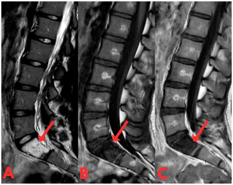 Sagittal T1, T2, and post-contrast MRI of non-enhancing intraosseous BNCT lesion