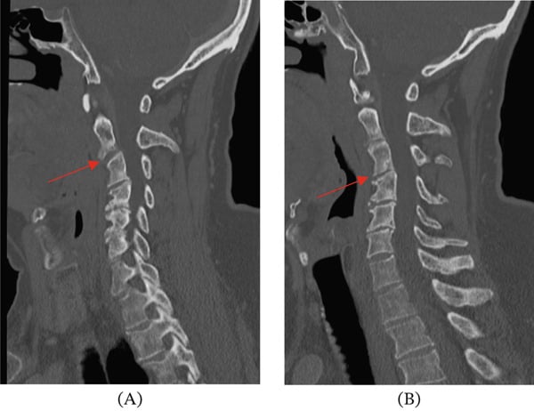 Whole-spine sagittal STIR MRI demonstrating multifocal BNCT lesions