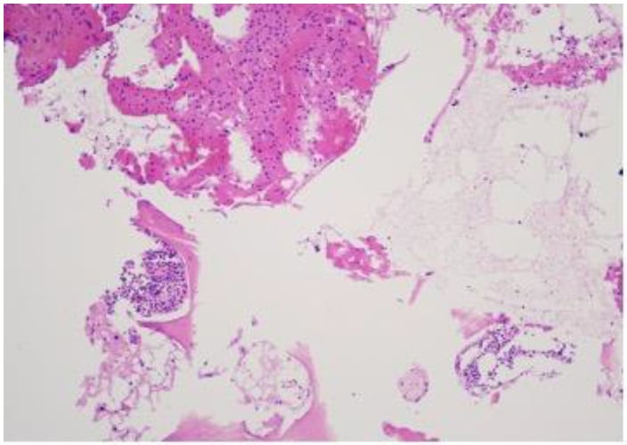 Histopathological H&E section of benign notochordal cell tumor