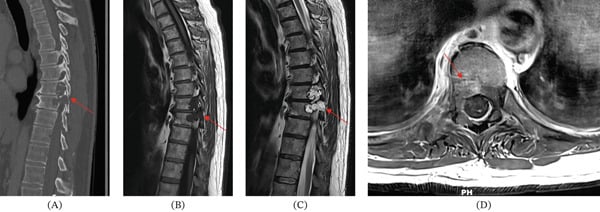 Sagittal and axial CT and MRI showing a chordoma at T8-T9 as a lytic destructive lesion with contrast enhancement