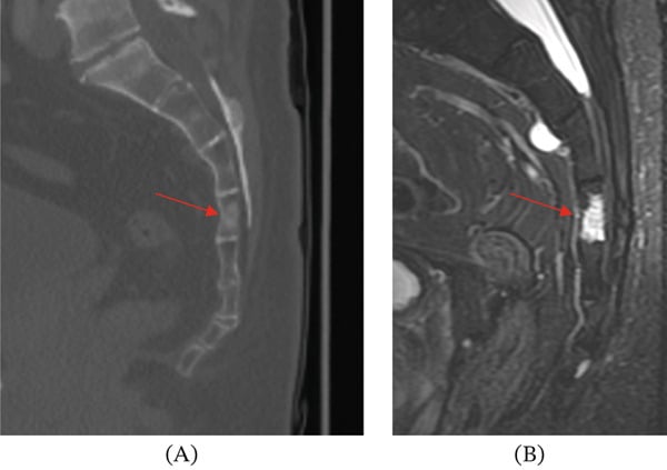 Sagittal CT and MRI showing a benign notochordal cell tumour at S4 as an intraosseous sclerotic lesion without destruction