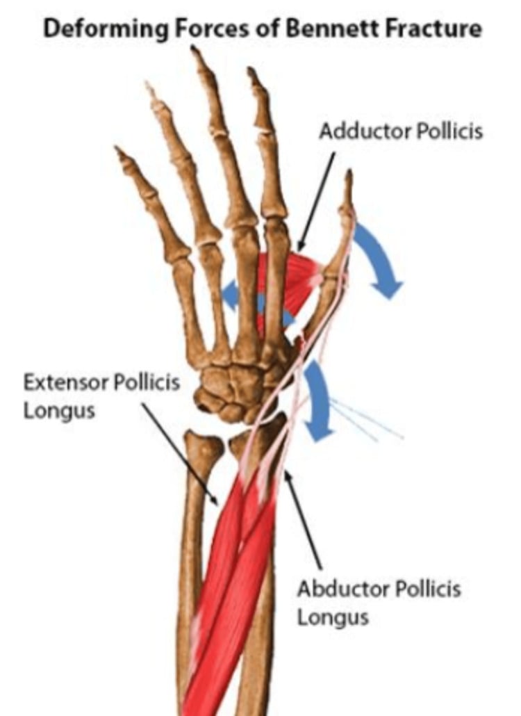 Anatomical illustration showing deforming forces in Bennett's fracture