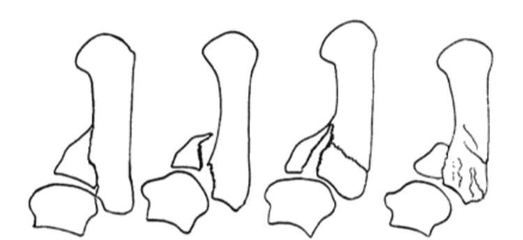 Gedda Type I Bennett's fracture patterns