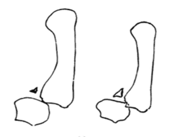 Gedda Type III Bennett's fracture pattern