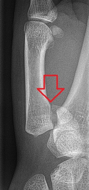 Radiograph of an acute Bennett's fracture at the base of the thumb metacarpal