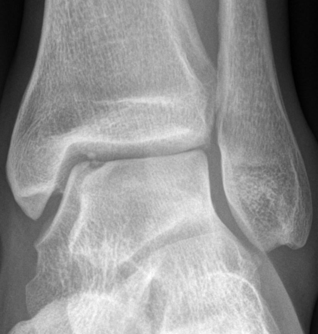 AP ankle radiograph showing a medial talar dome osteochondral lesion