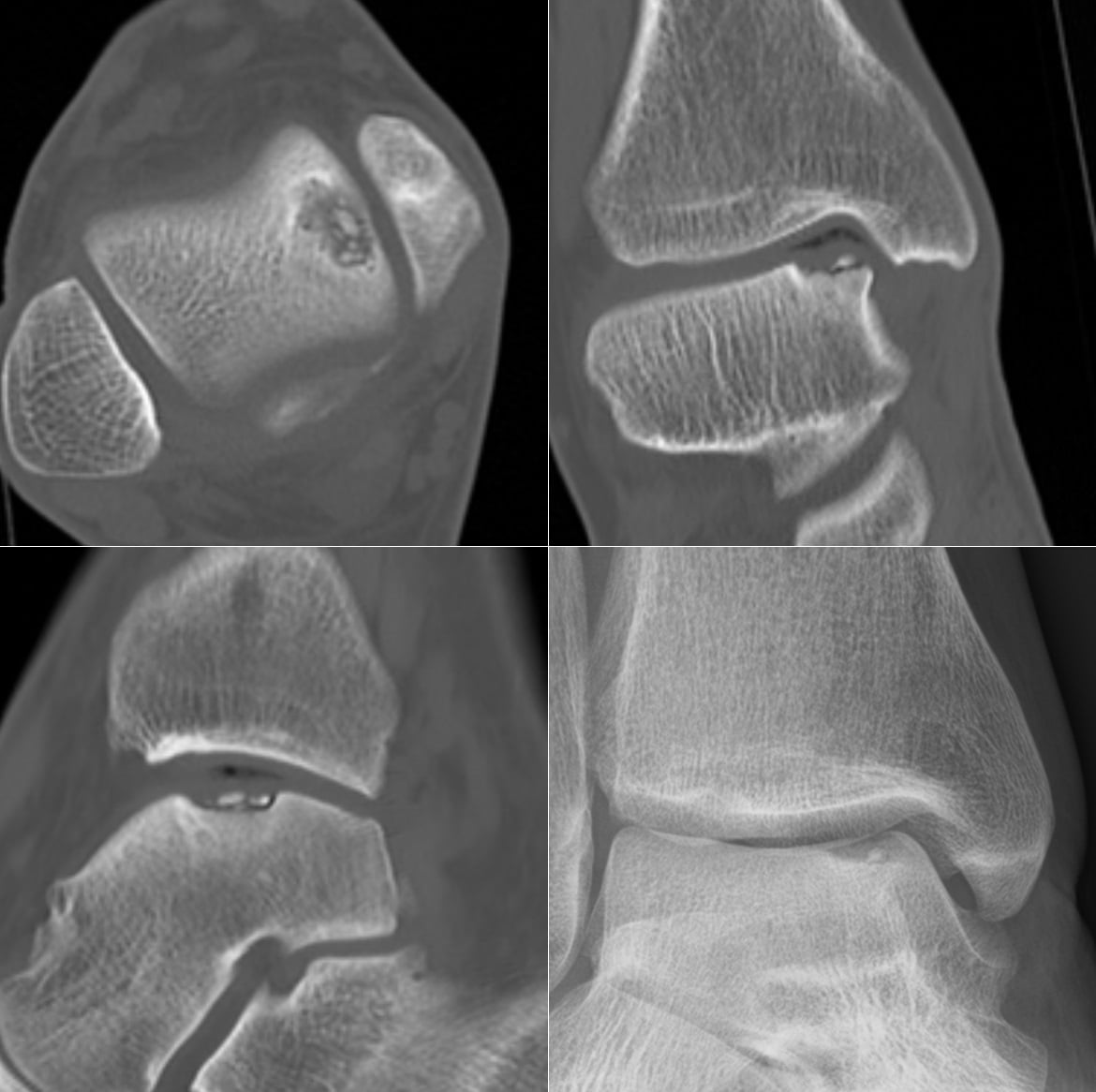 Four-panel CT (axial, coronal, sagittal) and plain radiograph of a talar dome osteochondral lesion