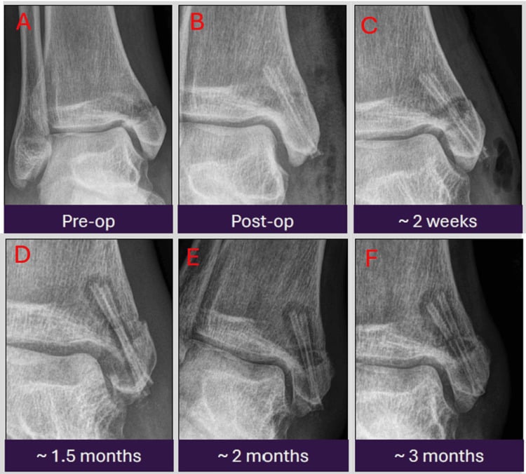 Serial AP radiographs demonstrating progressive magnesium screw degradation and gas radiolucency