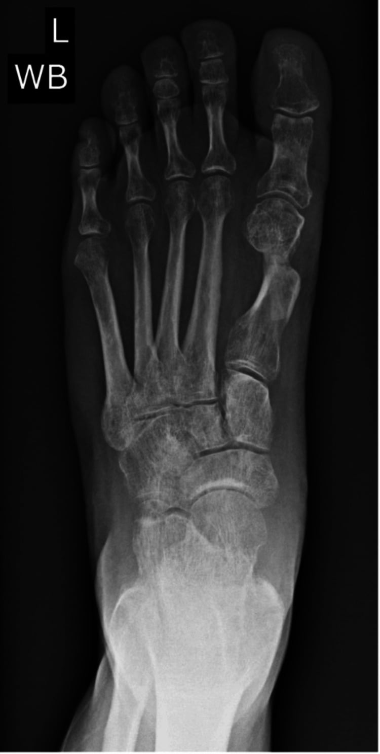 Weightbearing AP foot radiograph showing progressive magnesium screw degradation and callus formation