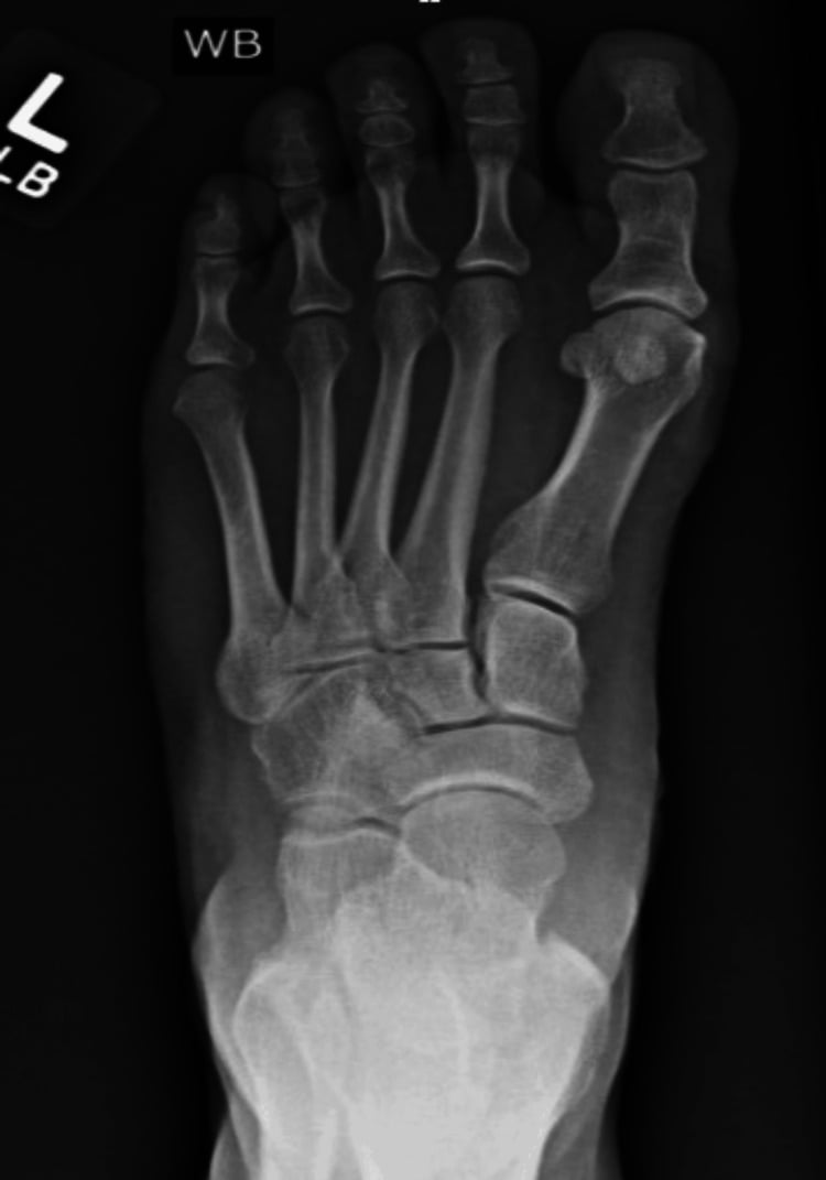 Preoperative weightbearing AP radiograph prior to magnesium screw osteotomy