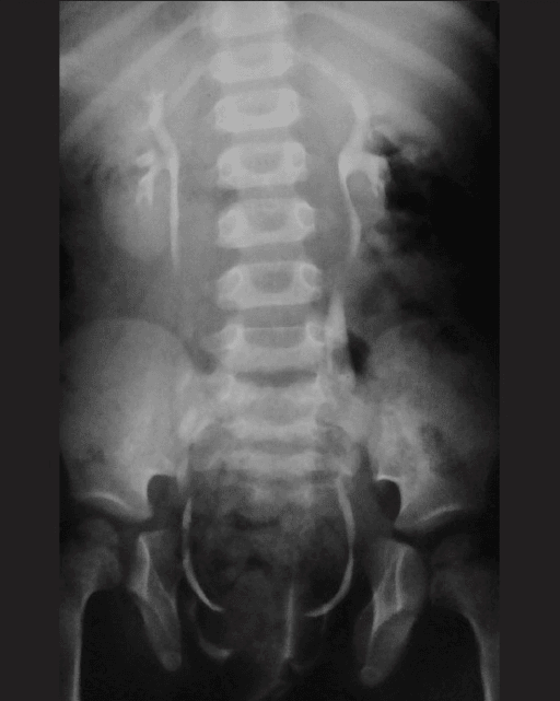 Abdominal urogram radiograph (X-ray) of a child with bladder exstrophy showing wide pubic diastasis