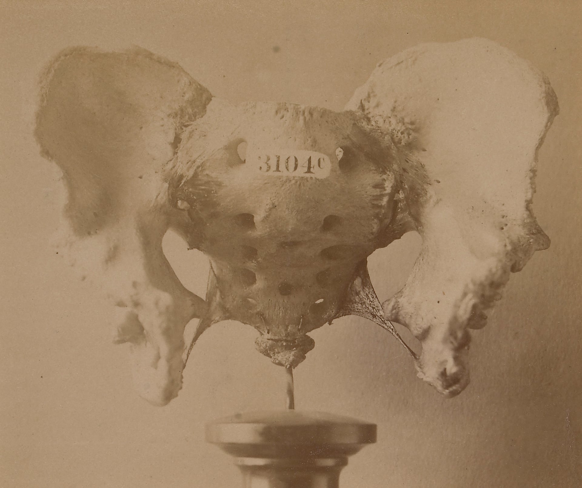 Dry adult pelvis specimen from a man with bladder exstrophy showing wide separation of the pubic bones