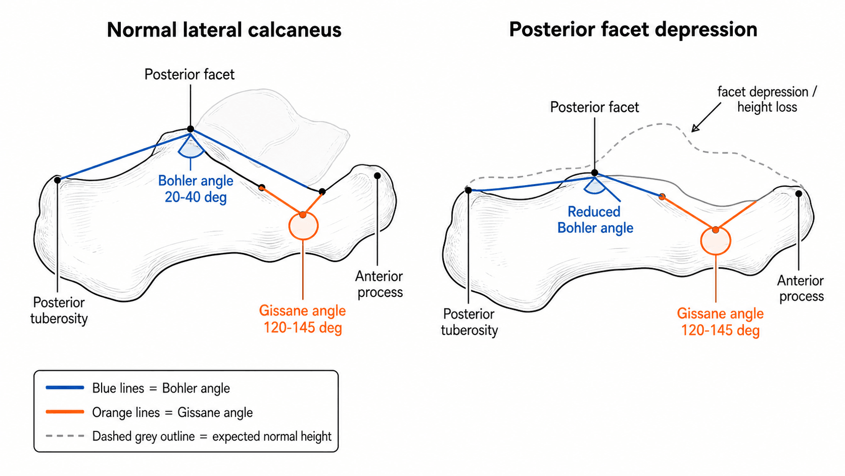 Bohler angle (20-40 degrees) and Gissane angle (120-145 degrees) on the lateral calcaneus, with posterior facet depression