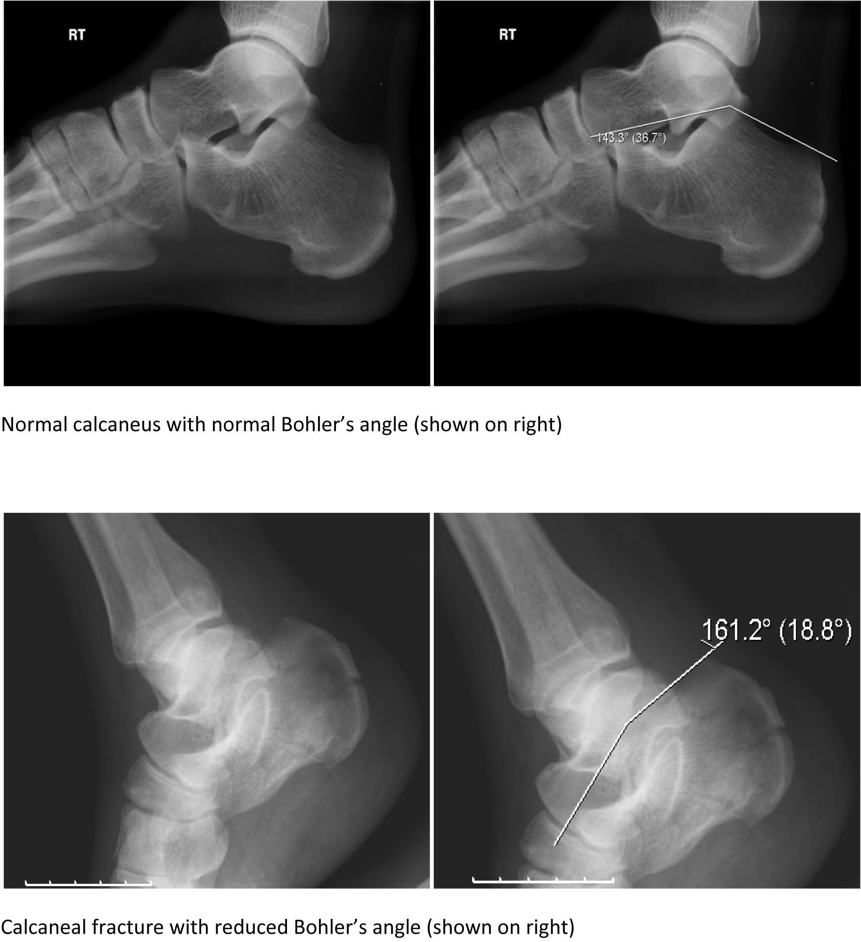Lateral calcaneal radiographs comparing a normal Bohler's angle with a flattened angle in a calcaneal fracture.