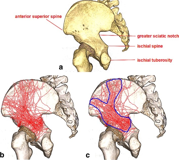 Fracture mapping of both column acetabular fractures showing Y-shaped pattern corridors