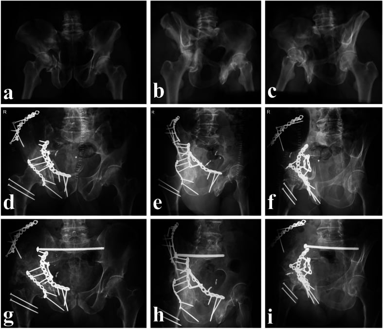 Three-dimensional reconstructions in anteroposterior, obturator and iliac projections showing quadrilateral plate displacement and medialisation of the femoral head, with postoperative films