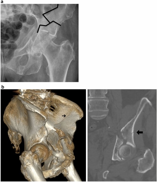 Radiograph, three-dimensional CT and axial CT showing complete separation of the acetabulum from the intact iliac bone, with an incomplete supra-acetabular component in a geriatric pattern