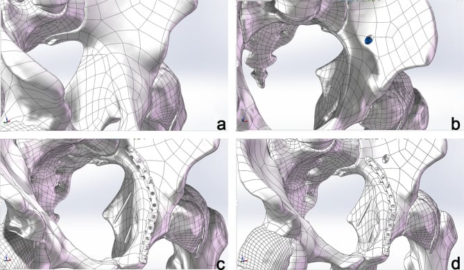 Finite element models of an unfixed acetabulum, posterior column screw fixation, quadrilateral buttress screws and a combined construct