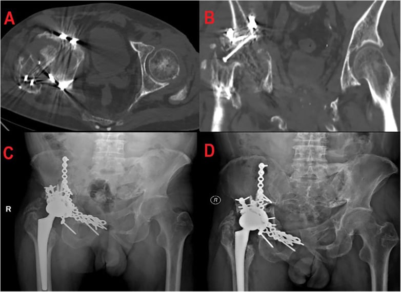 CT showing collapse and absence of the right femoral head from osteonecrosis with radiographs after total hip arthroplasty at thirty months